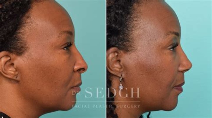 Angus Cloud Nose Job: Plastic Surgery Before Death