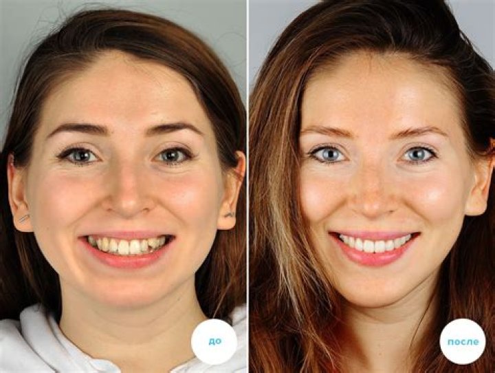 Jason Kelce Teeth Before And After: Has He Used Braces Or Whitening?