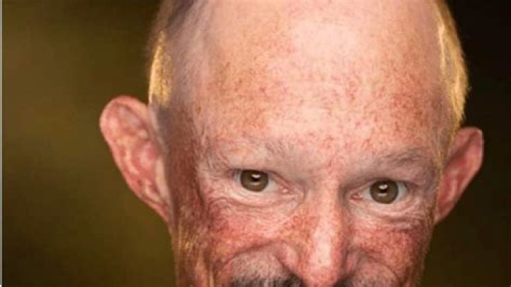 What Was Wrong With Darren Kent Face And Skin?
